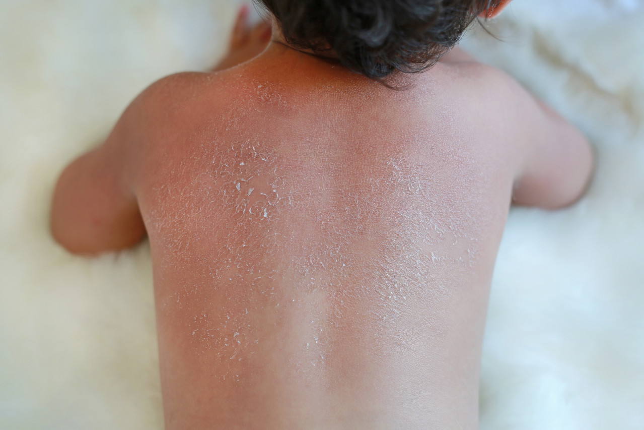 Сухая кожа на спине у ребенка
